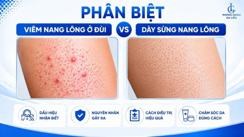 Viêm nang lông ở đùi và dày sừng nang lông