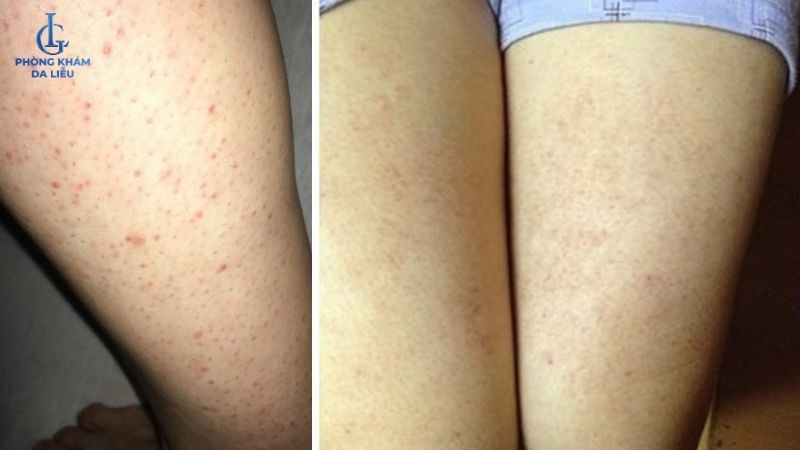 viêm nang lông ở đùi