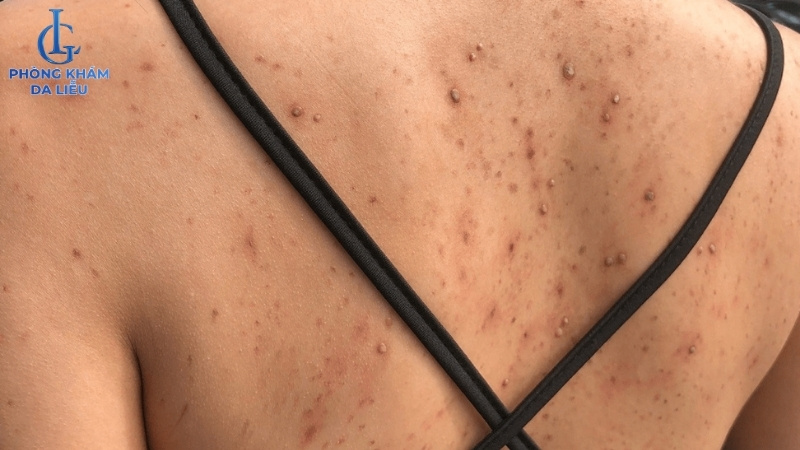 viêm nang lông ở lưng