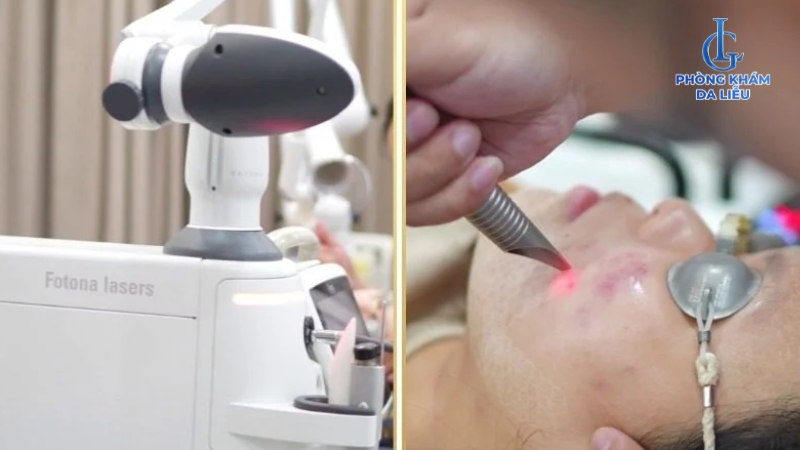 công nghệ trị viêm lỗ chân lông ở mặt
