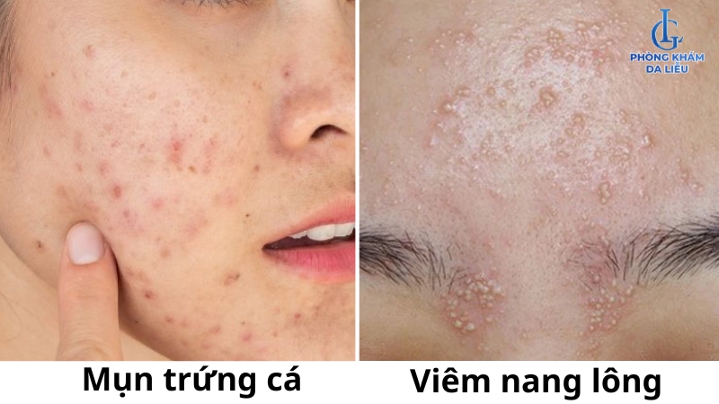 viêm nang lông mặt