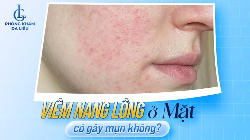 viêm nang lông ở mặt