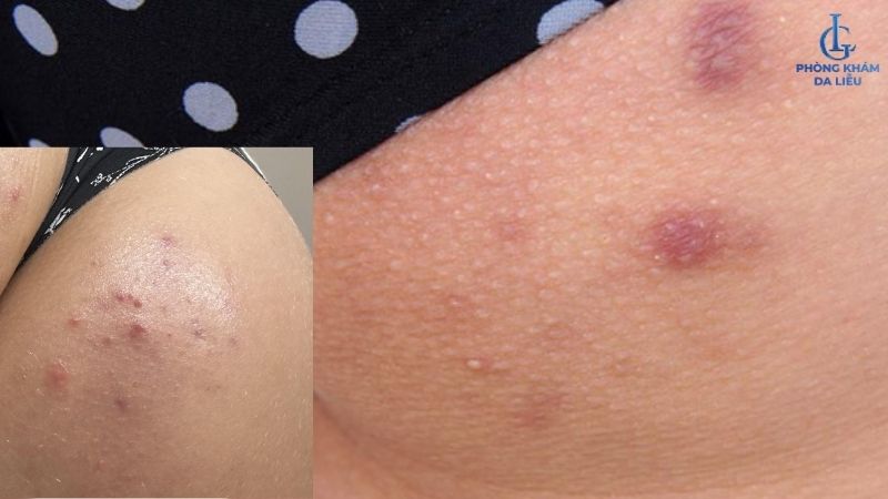 Hình ảnh viêm nang lông ở mông