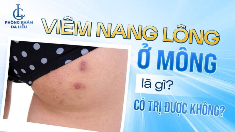 viêm nang lông ở mông