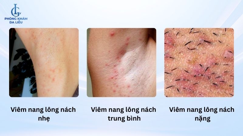 mức độ viêm nang lông nách