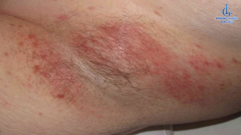 Hình ảnh viêm nang lông ở nách