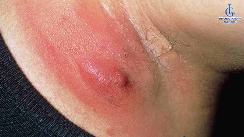 Áp xe do viêm nang lông nách