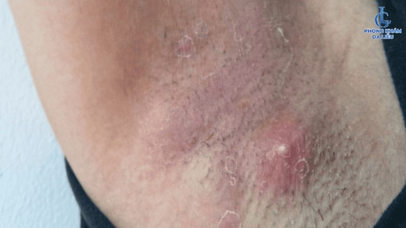 Hình ảnh viêm nang lông ở nách