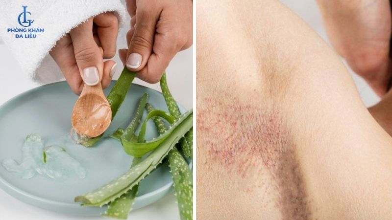 nha đam tươi chữa viêm nang lông nách