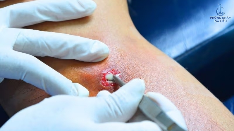 Rạch dẫn lưu mủ ở nách