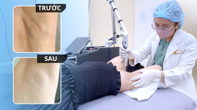 Acthyderm CO2 trị viêm nang lông nách