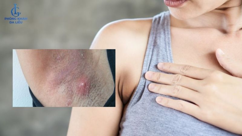 viêm nang lông ở nách
