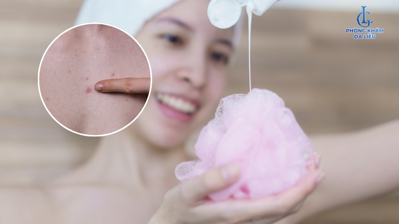 cải thiện trị viêm nang lông ngực