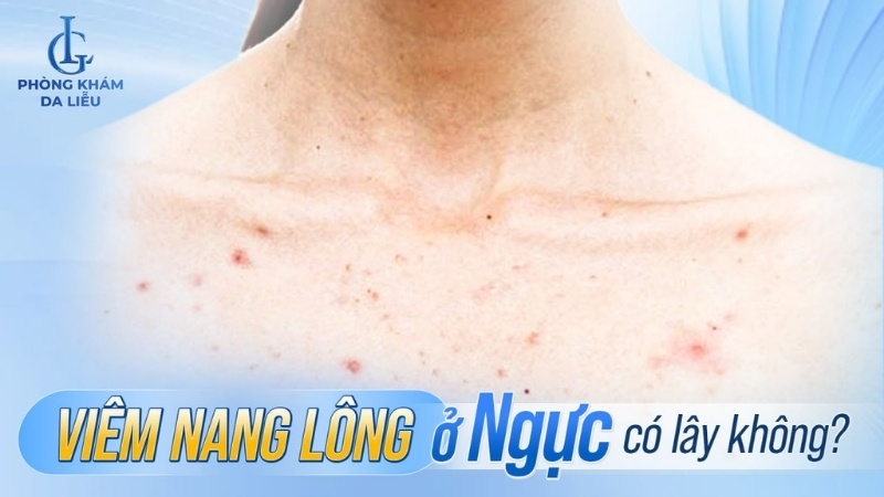 viêm nang lông ở ngực
