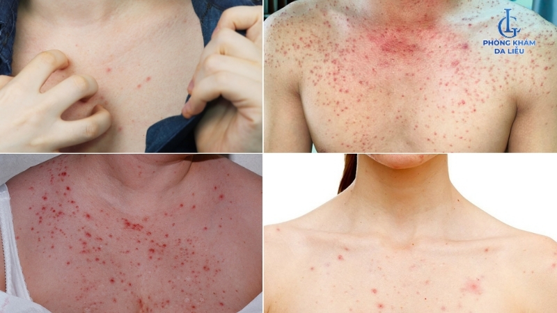 hỉnh ảnh viêm nang lông ở ngực