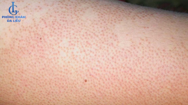 viêm nang lông ở tay