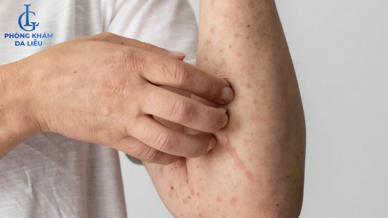 viêm nang lông ở tay