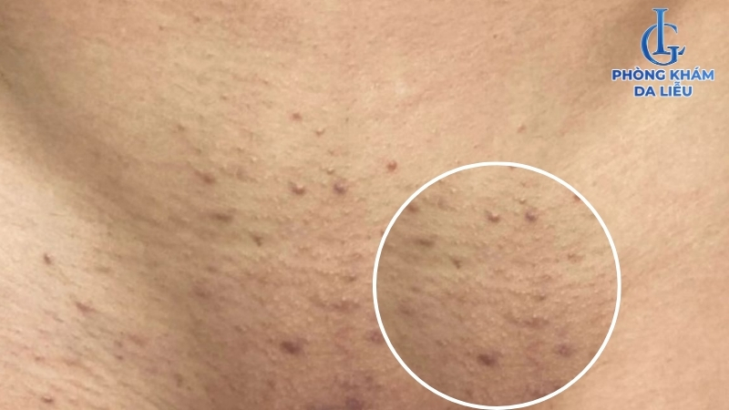 hình ảnh viêm nang lông vùng kín