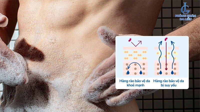 bị viêm nang lông vùng kín