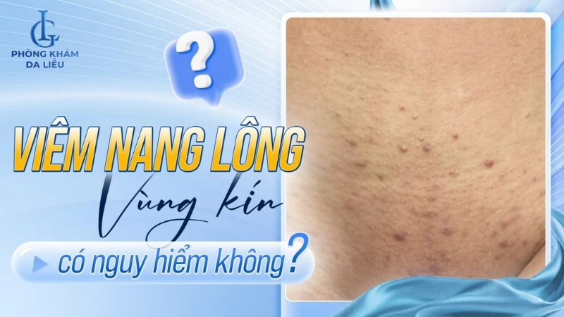 viêm nang lông vùng kín