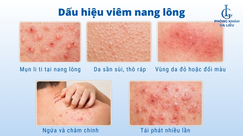 dấu hiệu viêm lỗ chân lông