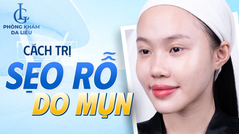 Cách trị sẹo rỗ tại nhà