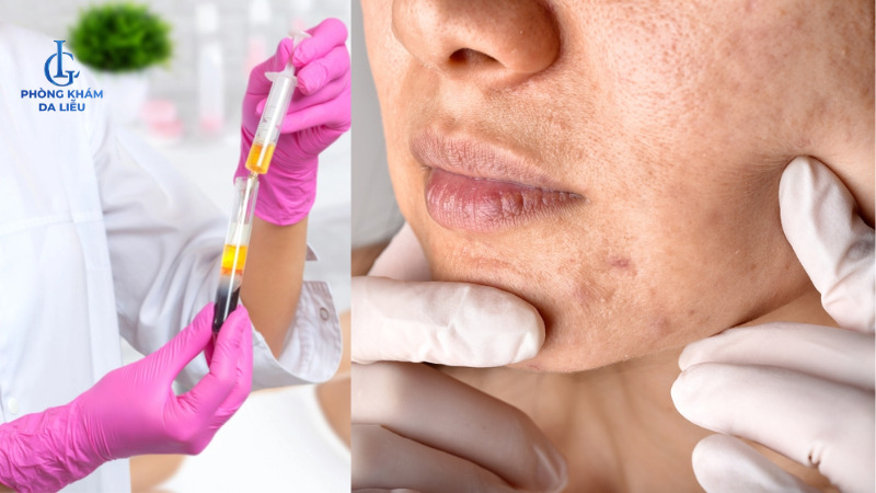 Tiêm PRP trị sẹo rỗ cho nam