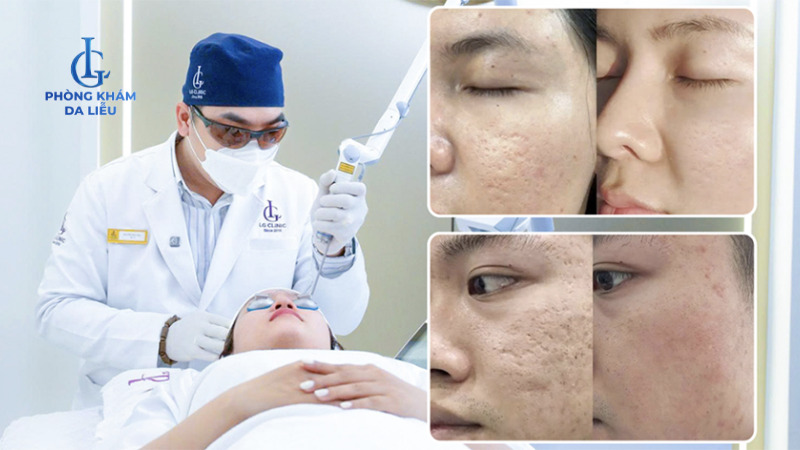 bác sĩ trị sẹo rỗ mụn