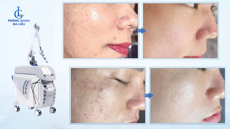 bắn laser trị sẹo rỗ