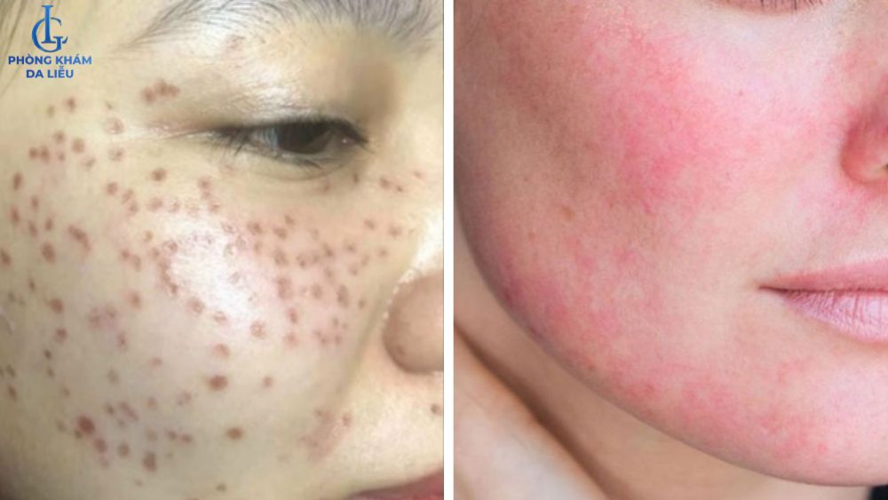 da sau bắn laser trị tàn nhang