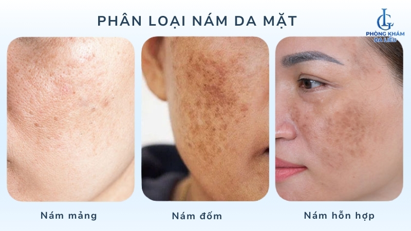 các loại nám da mặt phổ biến