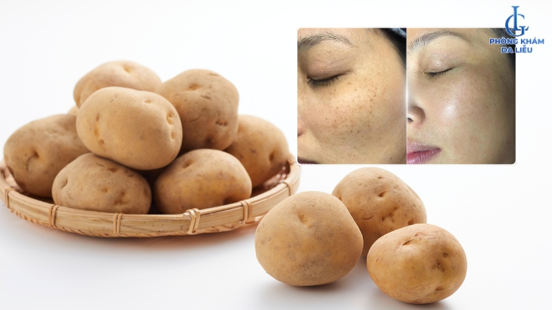 Cách trị nám sau sinh tại nhà