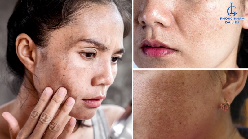 Hình ảnh nám sau sinh