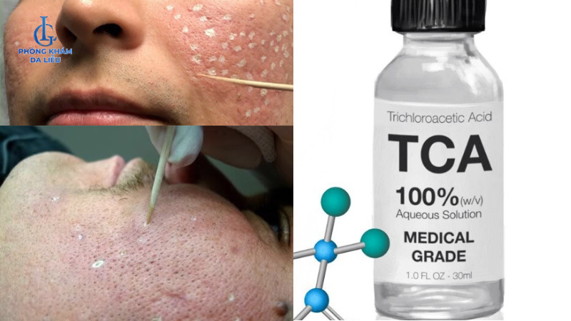 chấm cta trị sẹo rỗ cho nam