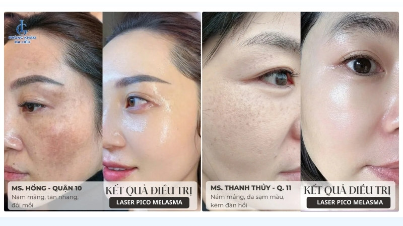 Trị quả điều trị nám