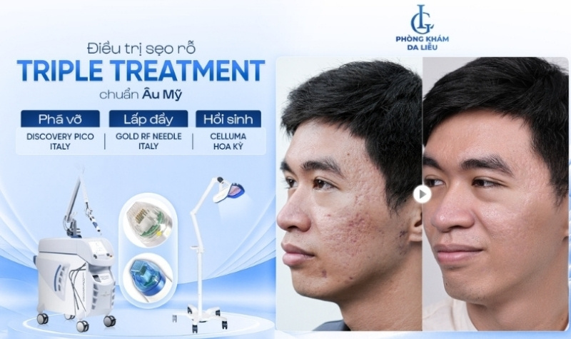 công nghệ điều trị sẹo rỗ triple treatment