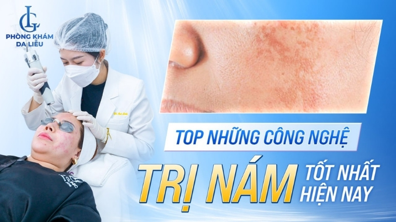 công nghệ trị nám tốt nhất hiện nay