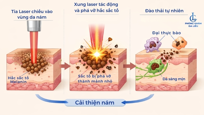 Cơ chế trị nám của laser