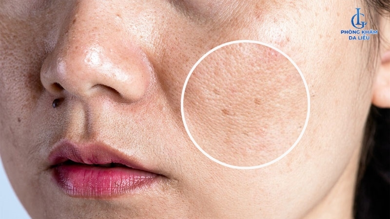 dấu hiệu bị nám da mặt