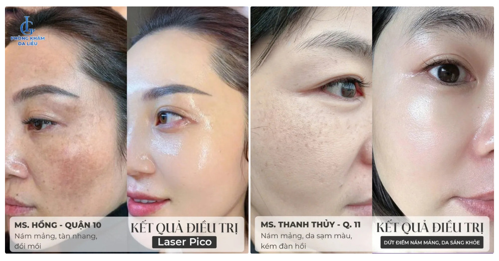 hiệu quả điều trị nám tại phòng khám