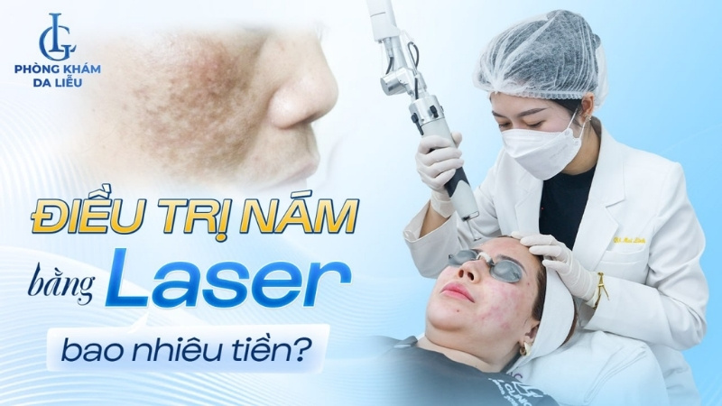 điều trị nám bằng laser bao nhiêu tiền