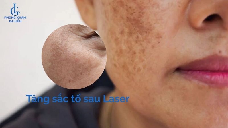 da bị tăng sắc tố