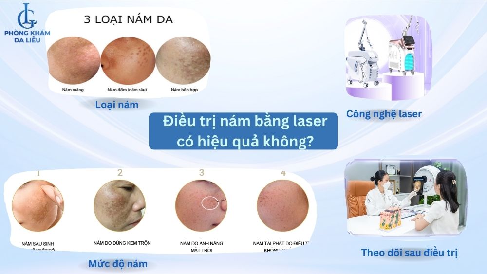 điều trị nám bằng laser có hiệu quả không