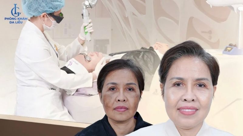 hiệu quả điều trị nám tại phòng khám