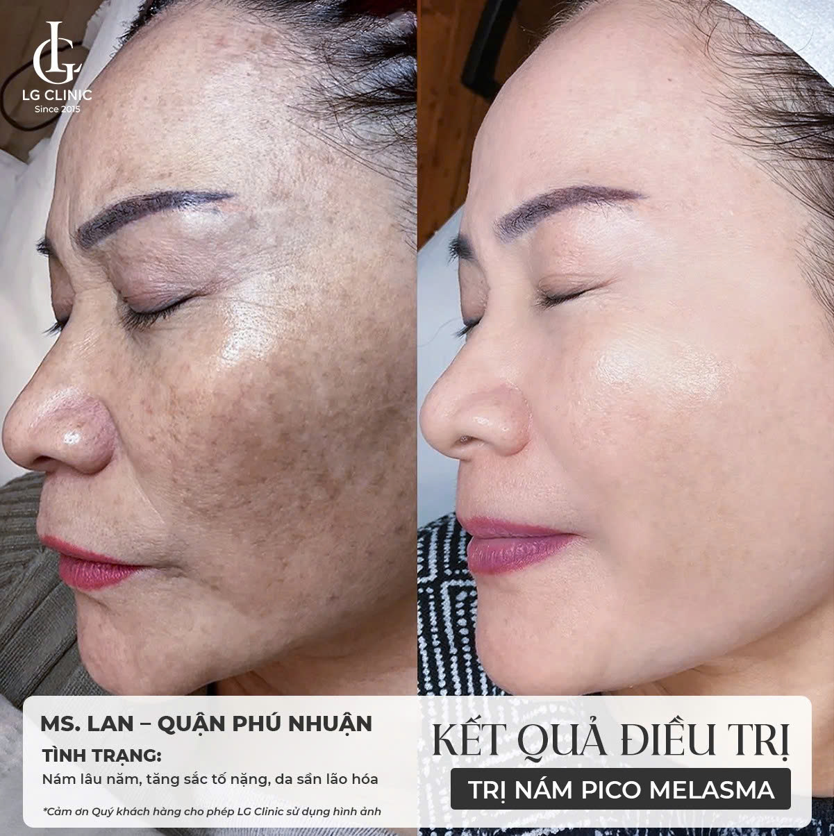 Kết quả điều trị nám