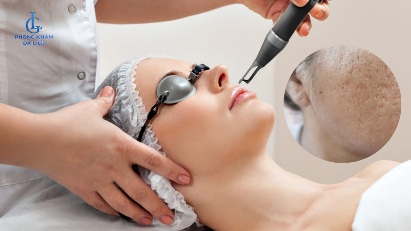điều trị sẹo rỗ bằng bắn laser