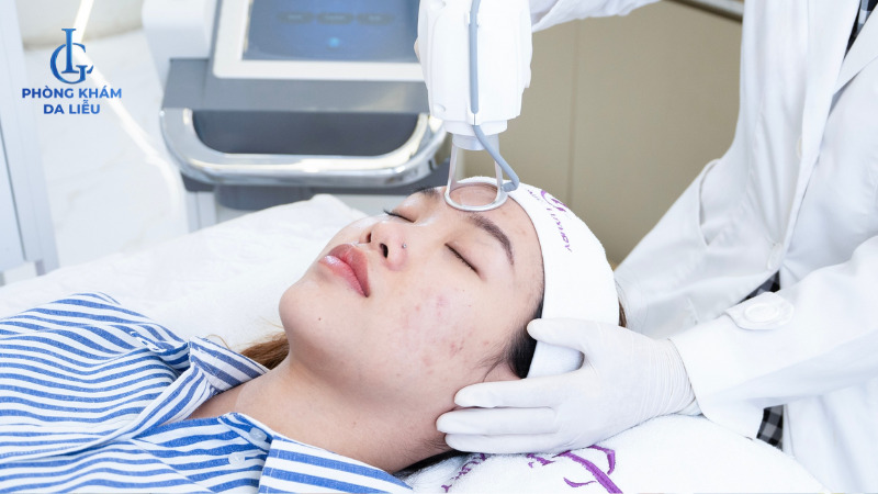 điều trị sẹo rỗ bằng laser