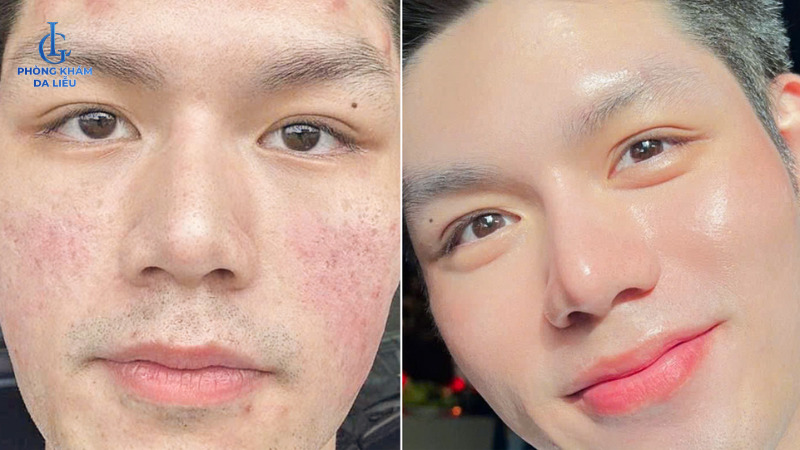 điều trị sẹo rỗ cho nam