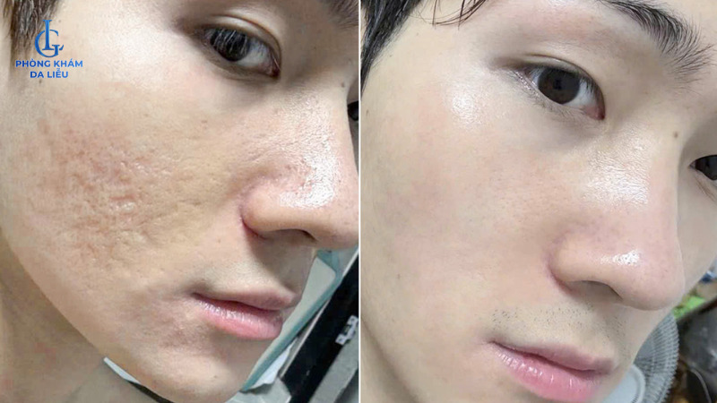 điều trị sẹo rỗ cho nam dứt điểm