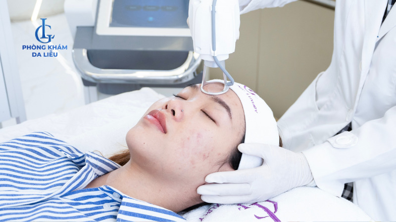 điều trị sẹo rỗ do mụn dứt điểm